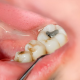 Things to Know About the Dental Filling Treatment