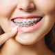 6 Things to Consider Before Getting Dental Braces