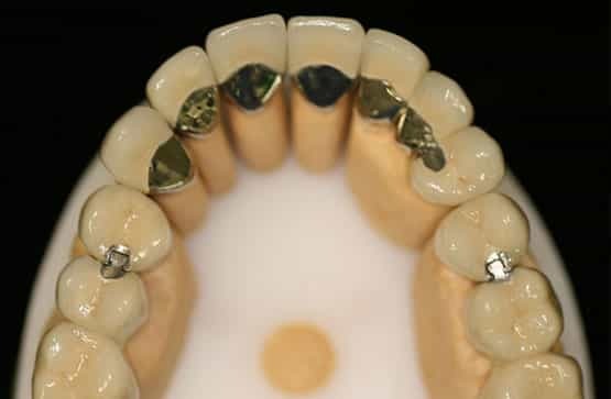 Crown and bridge treatments restore damaged or missing teeth, improving function and appearance.
