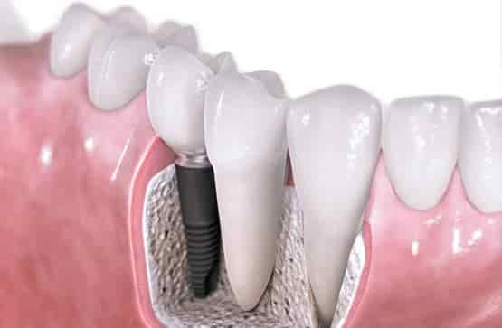 Dental implants are a solution for missing teeth, offering a natural look & feel with long-term stability.