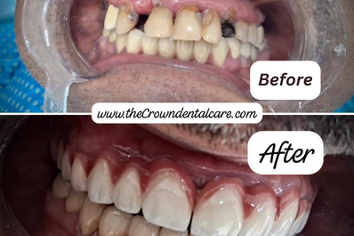 A tooth with a cavity with a white filling shows the before & after of teeth filling treatment. 