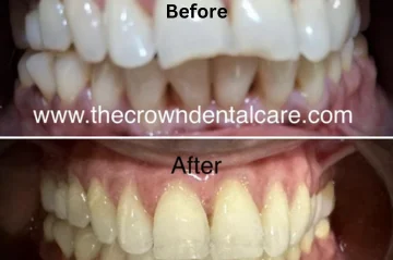 Before and after photos showcasing the transformative effects of teeth whitening & Replaced teeth.