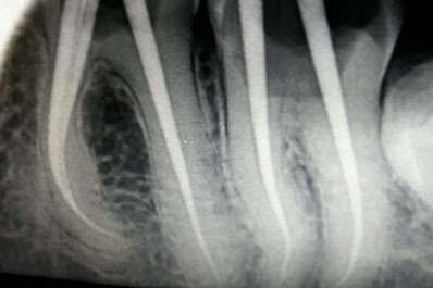 patient's x-ray report was taken for the root canal treatment process in a dental clinic in Coimbatore