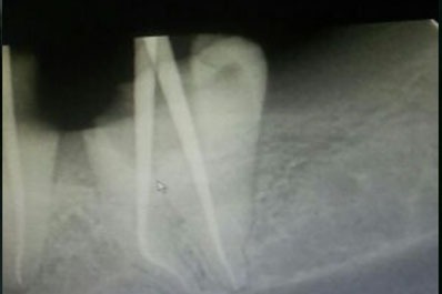 A dental x-ray shows a single tooth in the oral cavity and shows the results of a dental examination