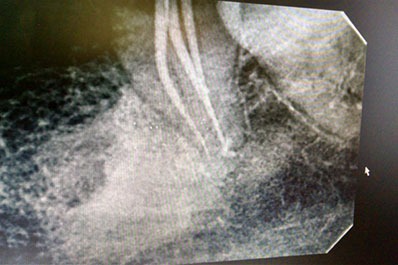 Dental X-ray image showing dental roots and surrounding bone structure during dental treatment .