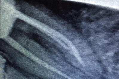 X-ray image taken during dental treatment that displays the surrounding bone structure and tooth roots.