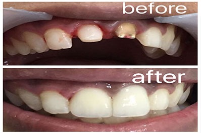 Before and after a dental implant A parallel photo compares a dental implant to the lost tooth.