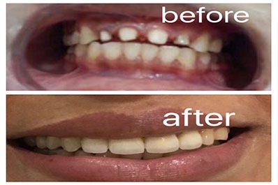 Before and after photos show how dental implants may transform teeth and improve their looks.