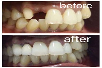 Dental implants restore missing teeth and give smiles a more confident and natural appearance.