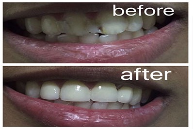 Comparison of teeth before and after whitening treatment shows color and brightness improvement.
