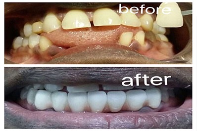 Pictures showing the amazing outcomes of teeth whitening and replacing teeth before and after.