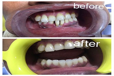 An illustration of teeth before and after straightening treatment, showing the change in alignment.