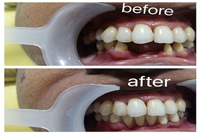A comparison of the patient's teeth before and after dental treatment reveals major changes.