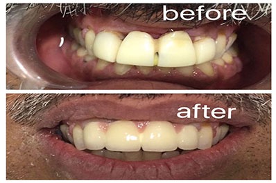 Comparison of the patient's teeth before and after dental treatment shows significant improvement.