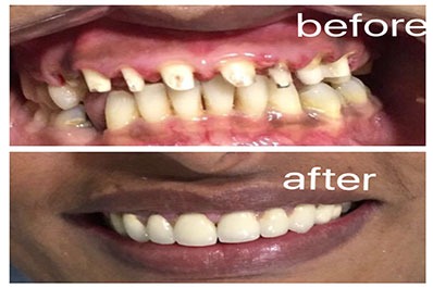 Before & after images of the transformation of teeth from missing to restored with a dental implant.