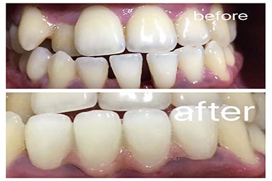 Before & after images of teeth with dental implants, showcasing transformation & improved oral health.