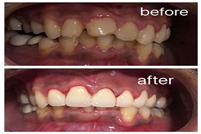 Before and after photos showcasing the transformative effects of teeth-whitening treatments.