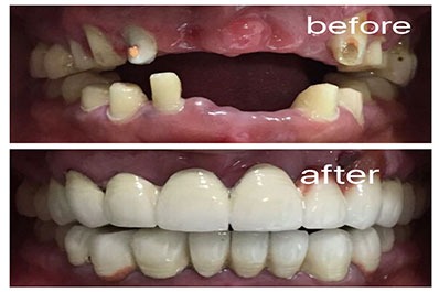 Teeth before & after having dental replacement treatment for lost teeth show changes in the teeth