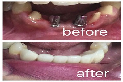 A visual representation of teeth taken before and after receiving a root canal treatment. 