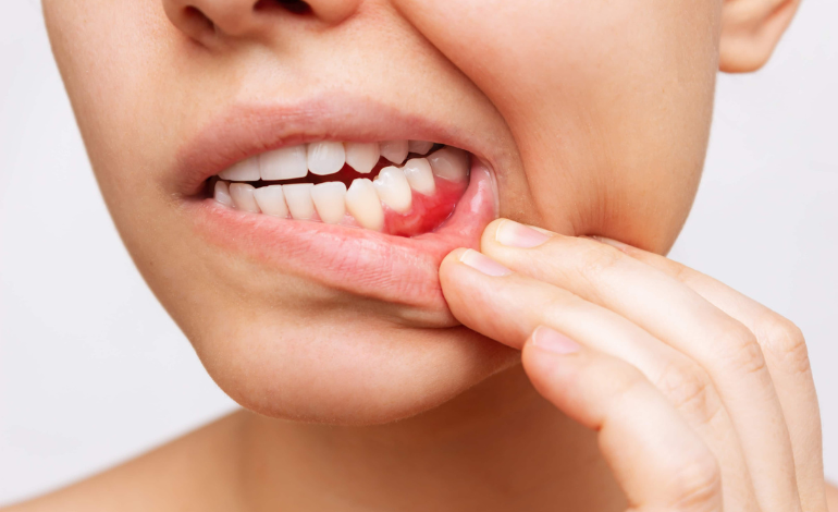 Gum disease prevention focuses on maintaining healthy gums and teeth through regular care.