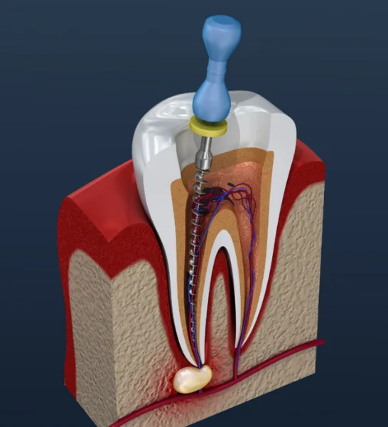 A tooth with a dental implant and a root-canal treated tooth stand next to a natural root tooth.