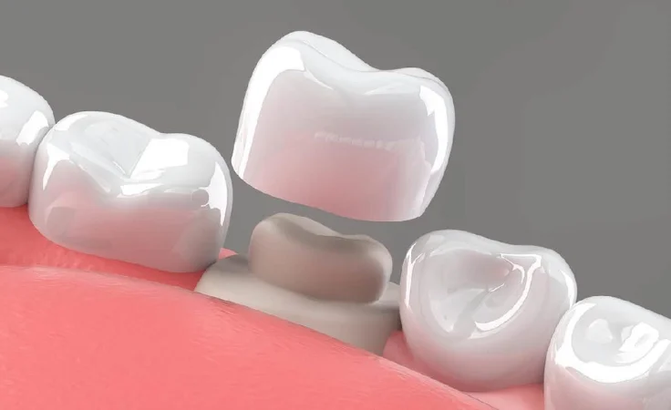 In a common dental treatment for dental-crowns, an implant is implanted with a crown on top.