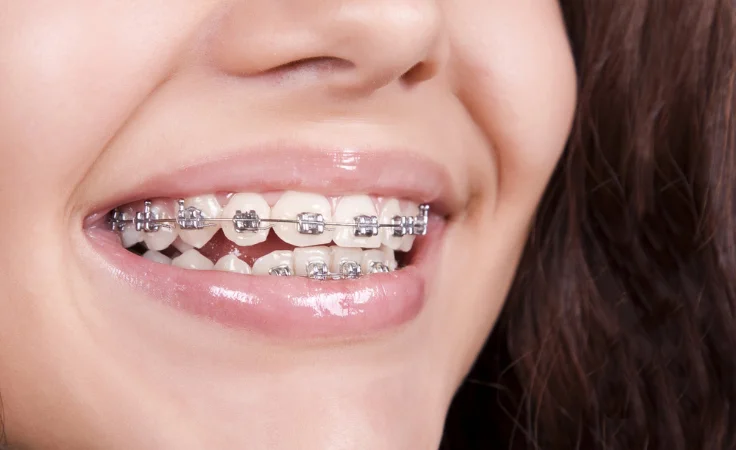 A woman wearing orthodontics grinning, her lovely countenance exuding confidence and contentment.