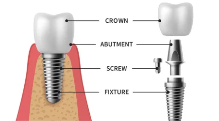 A tooth is held in place by a dental implant, demonstrating the success of the dental surgery.