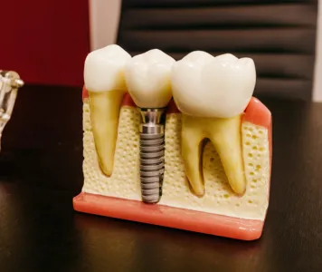 An implant-equipped tooth is illustrated in the dental model, demonstrating crown-bridge-treatment.
