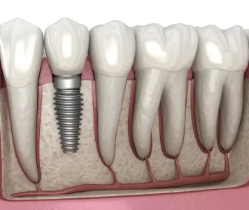 A dental implant holds a tooth in place, showcasing the successful outcome of the dental surgery.