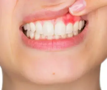 The woman's red gums and teeth are prominently displayed in this close-up, potential health issues.